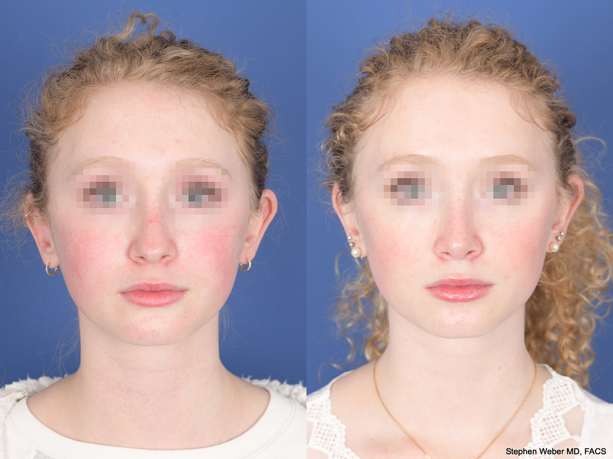 Rhinoplasty Before and After | Weber Facial Plastic Surgery