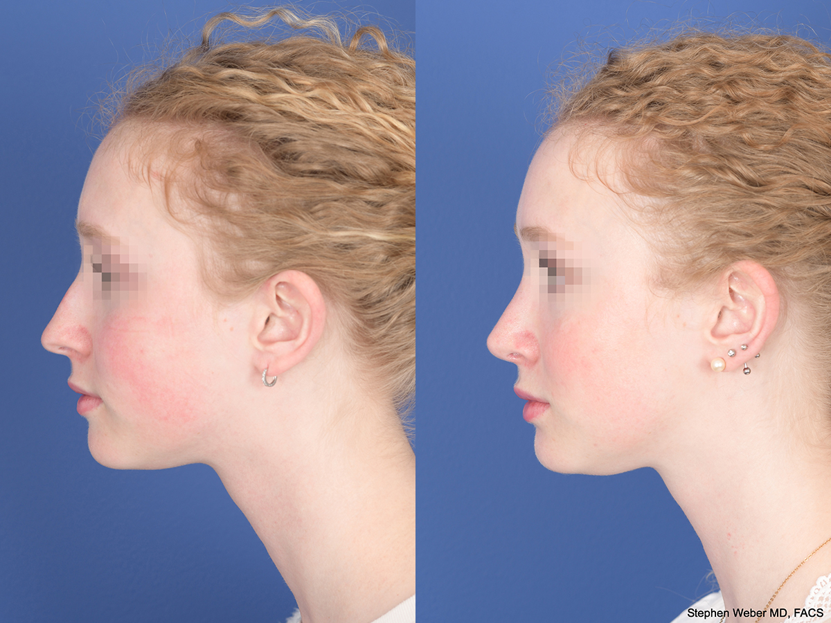 Rhinoplasty Before and After | Weber Facial Plastic Surgery