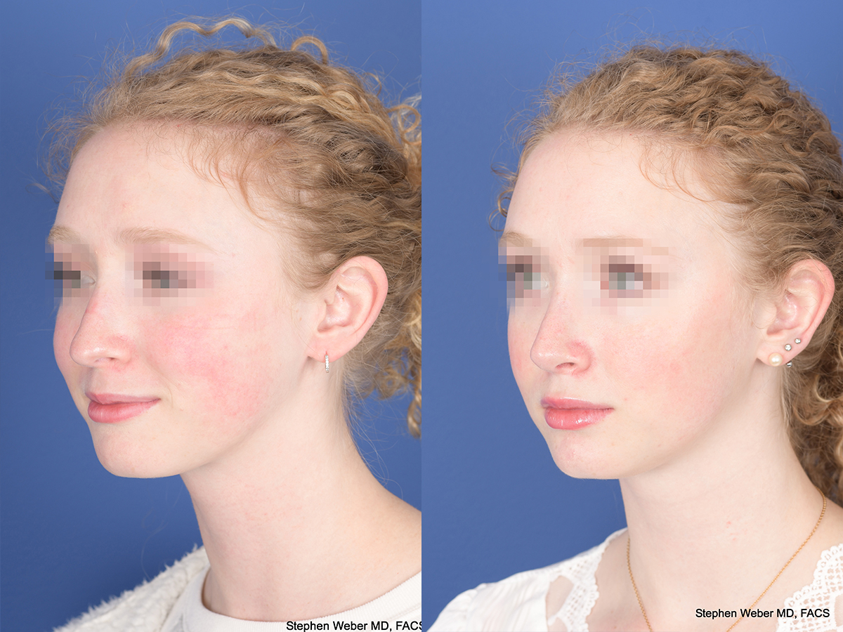 Rhinoplasty Before and After | Weber Facial Plastic Surgery