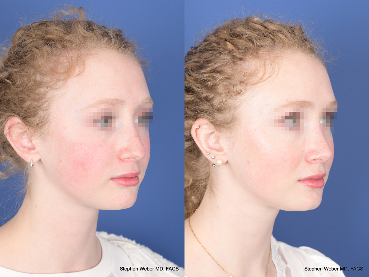 Rhinoplasty Before and After | Weber Facial Plastic Surgery