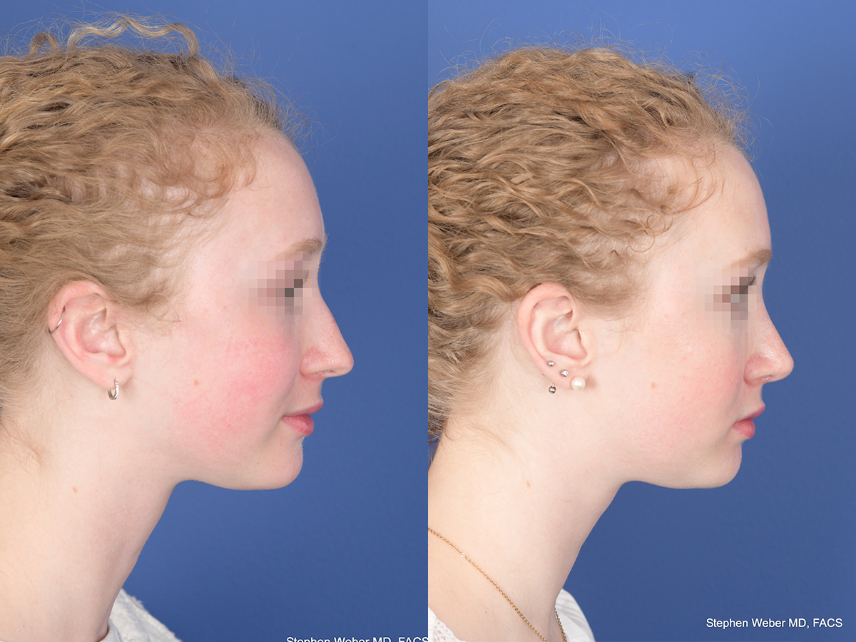Rhinoplasty Before and After | Weber Facial Plastic Surgery