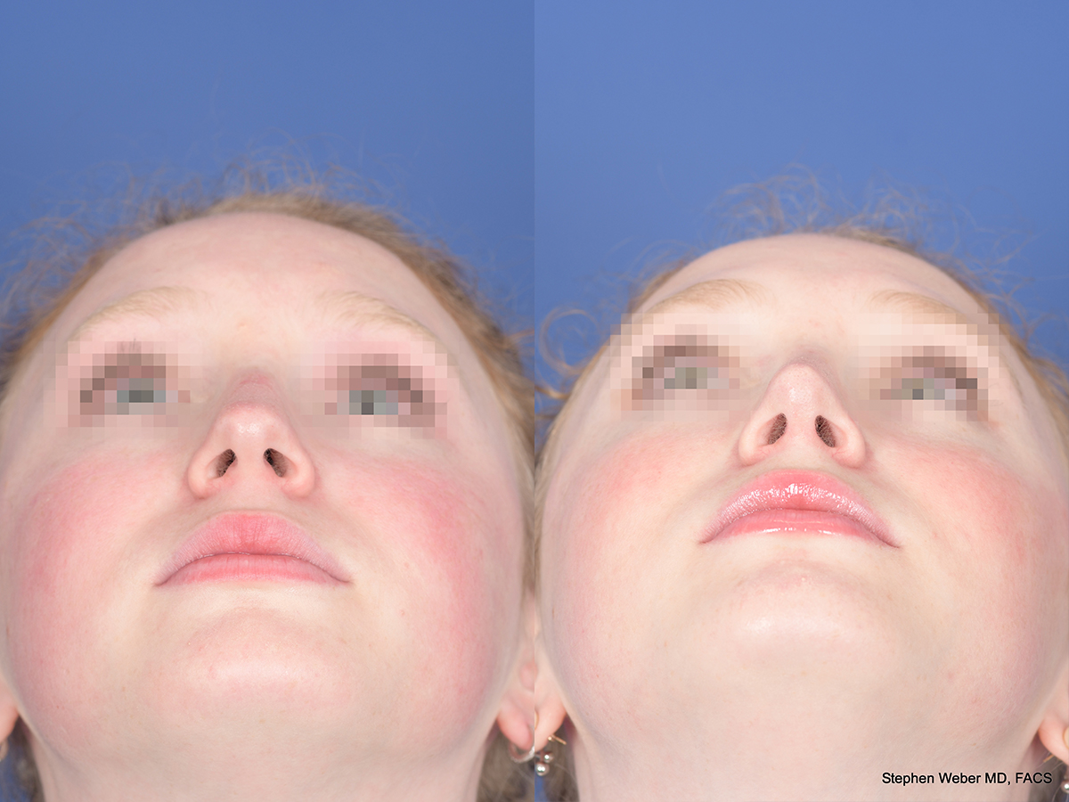 Rhinoplasty Before and After | Weber Facial Plastic Surgery