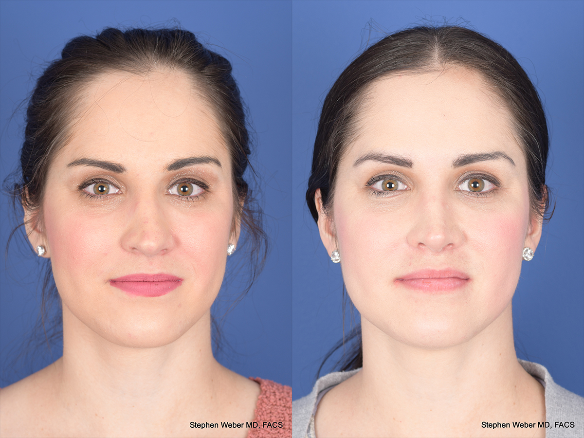 Rhinoplasty Before and After | Weber Facial Plastic Surgery