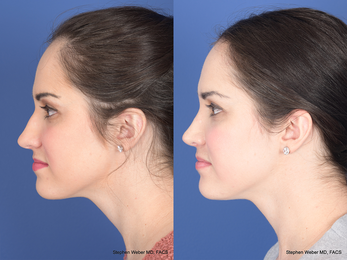Rhinoplasty Before and After | Weber Facial Plastic Surgery