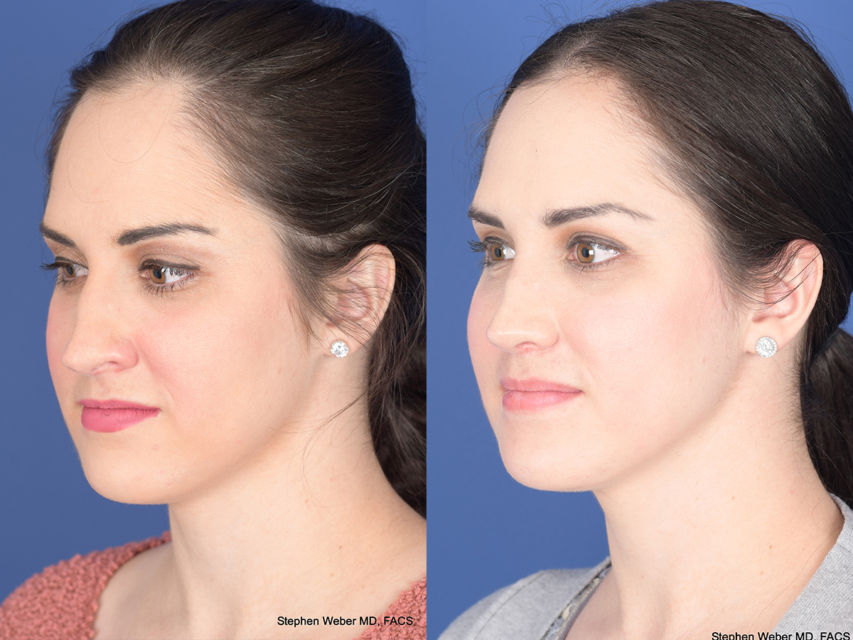 Rhinoplasty Before and After | Weber Facial Plastic Surgery