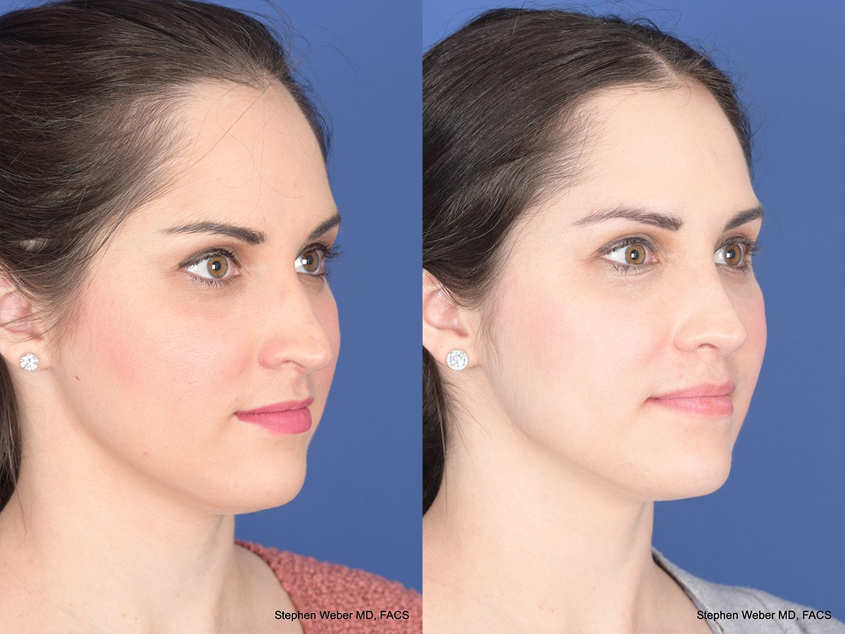 Rhinoplasty Before and After | Weber Facial Plastic Surgery
