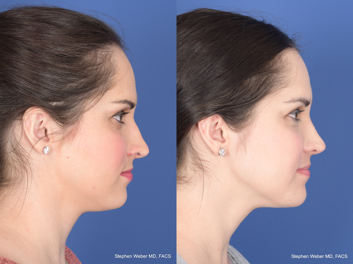 Rhinoplasty Before and After | Weber Facial Plastic Surgery