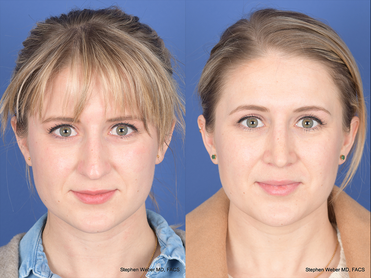 Rhinoplasty Before and After | Weber Facial Plastic Surgery