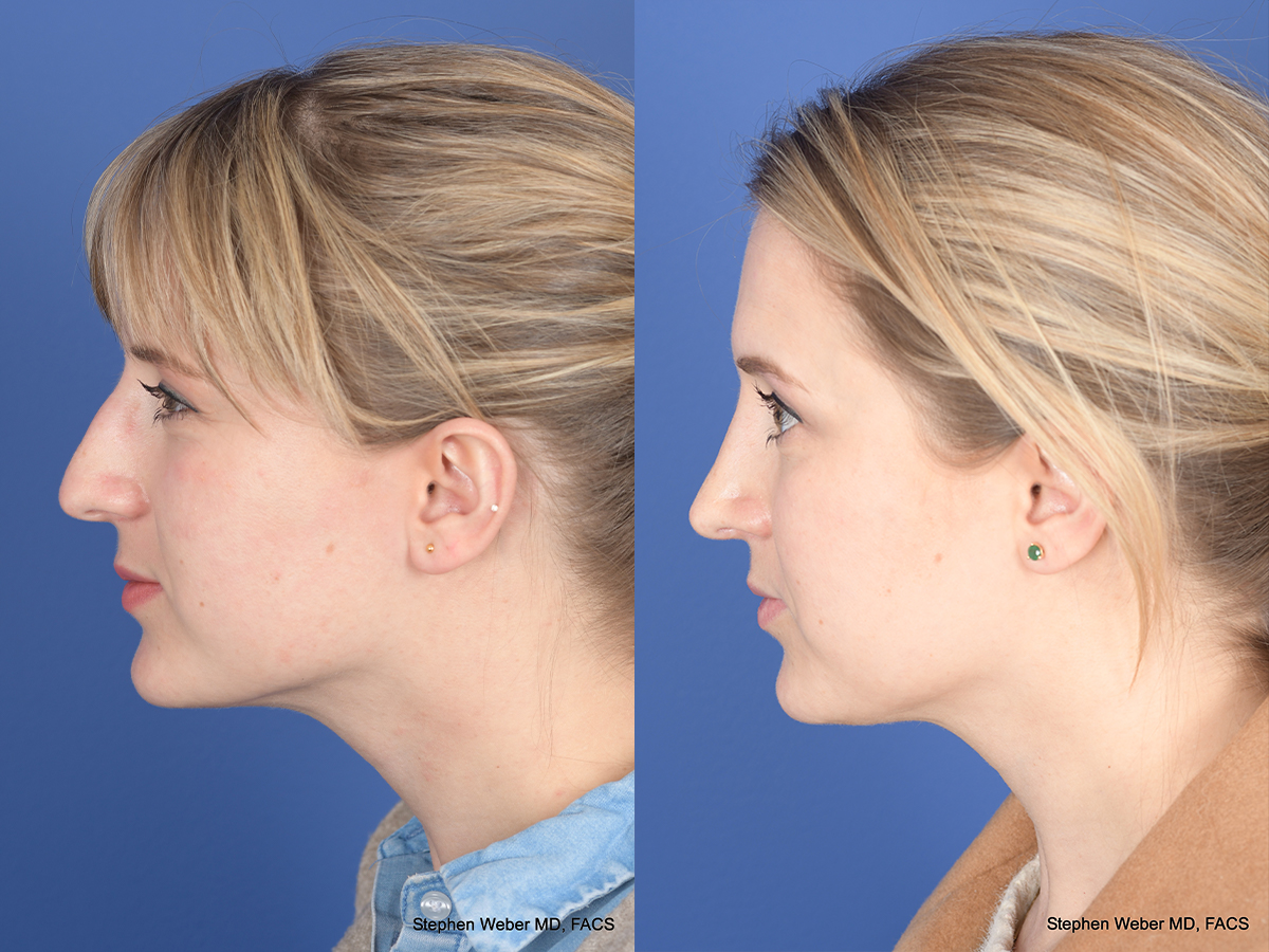 Rhinoplasty Before and After | Weber Facial Plastic Surgery