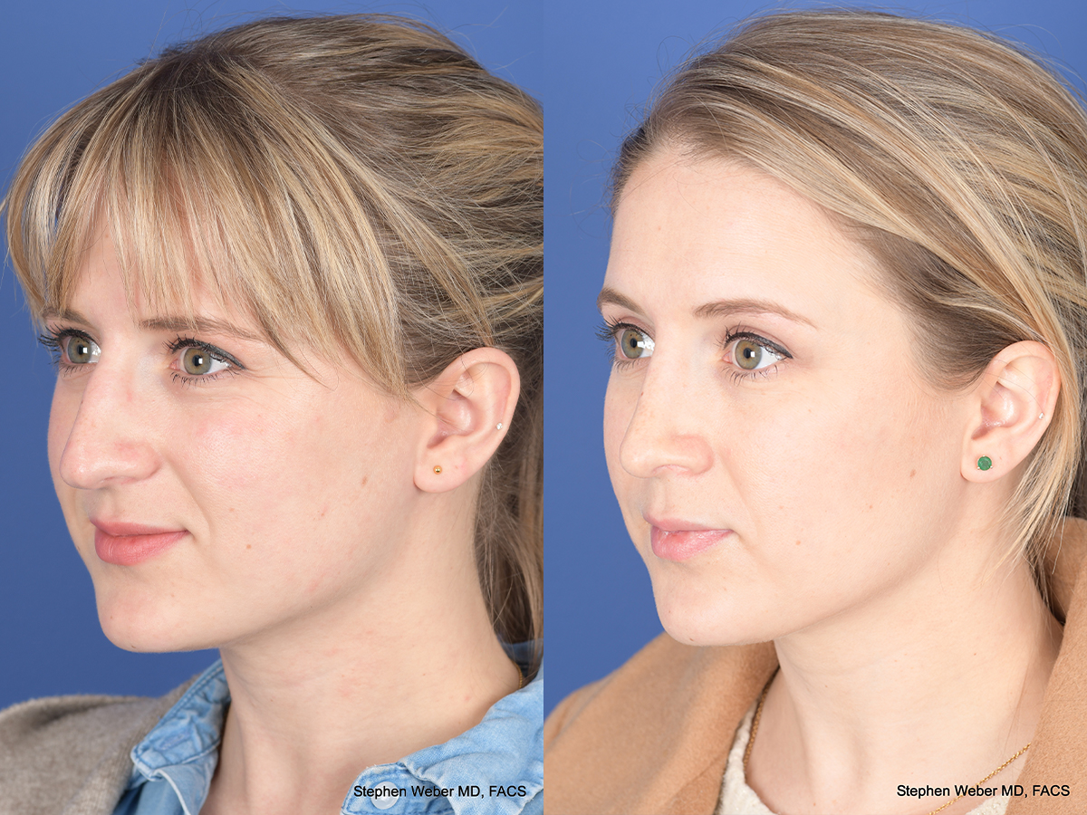 Rhinoplasty Before and After | Weber Facial Plastic Surgery