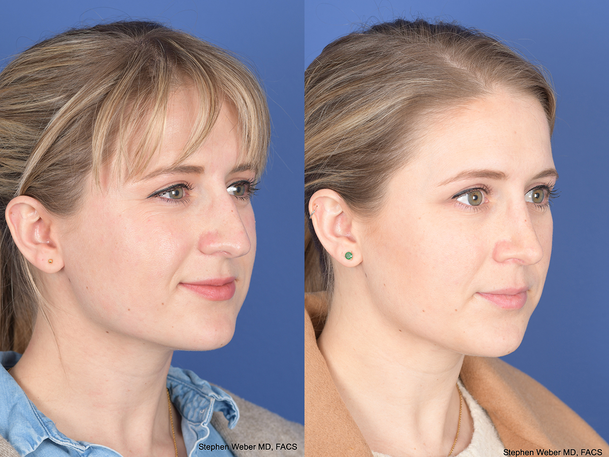 Rhinoplasty Before and After | Weber Facial Plastic Surgery