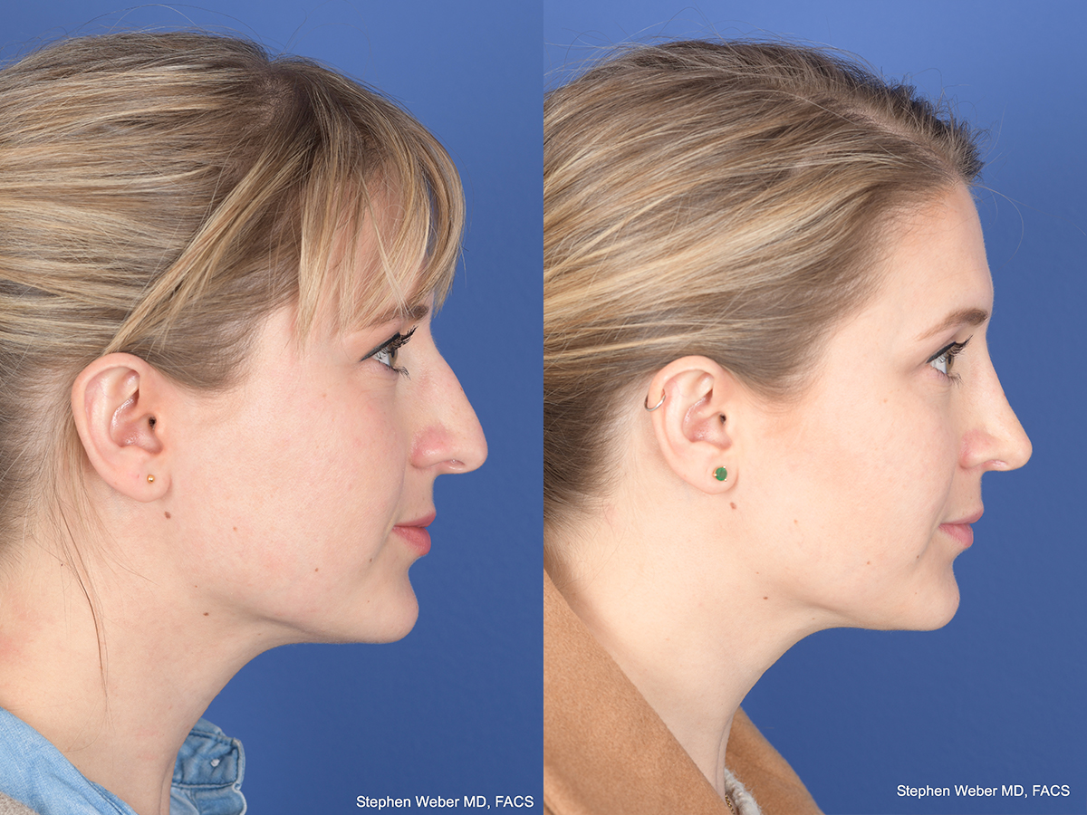 Rhinoplasty Before and After | Weber Facial Plastic Surgery