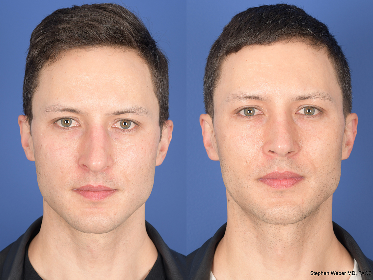 Rhinoplasty Before and After | Weber Facial Plastic Surgery