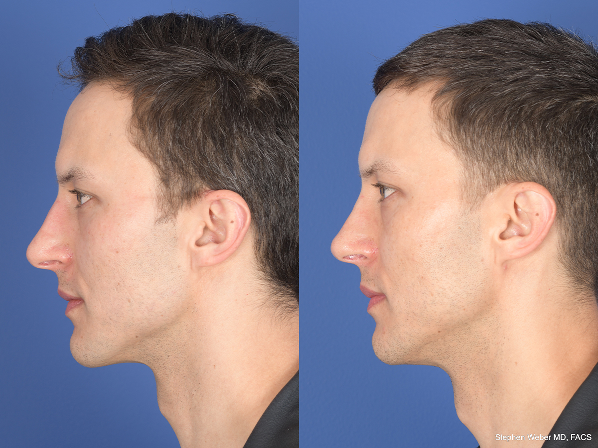 Rhinoplasty Before and After | Weber Facial Plastic Surgery