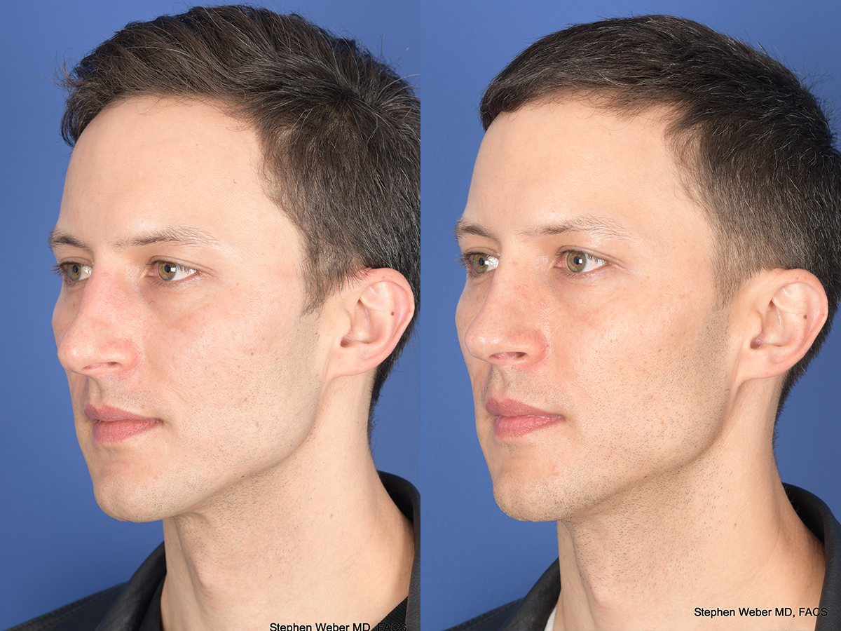 Rhinoplasty Before and After | Weber Facial Plastic Surgery