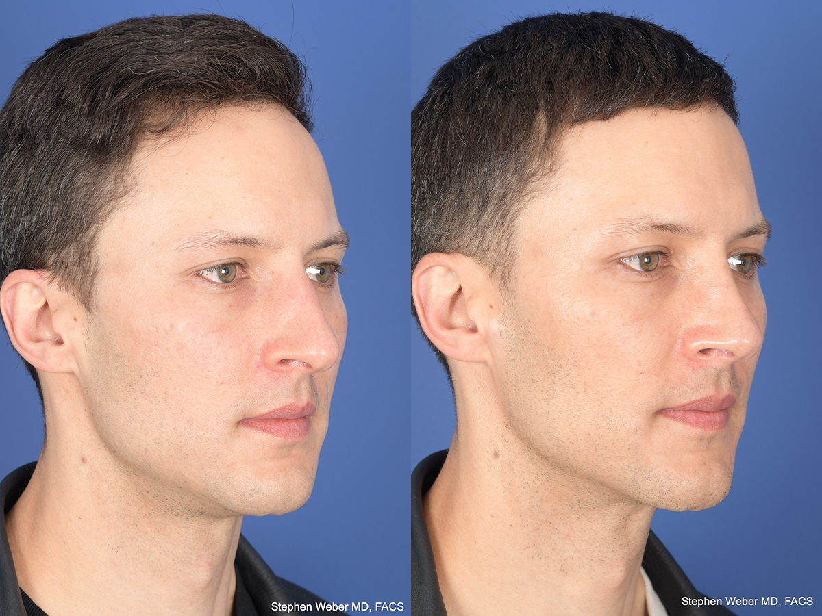 Rhinoplasty Before and After | Weber Facial Plastic Surgery