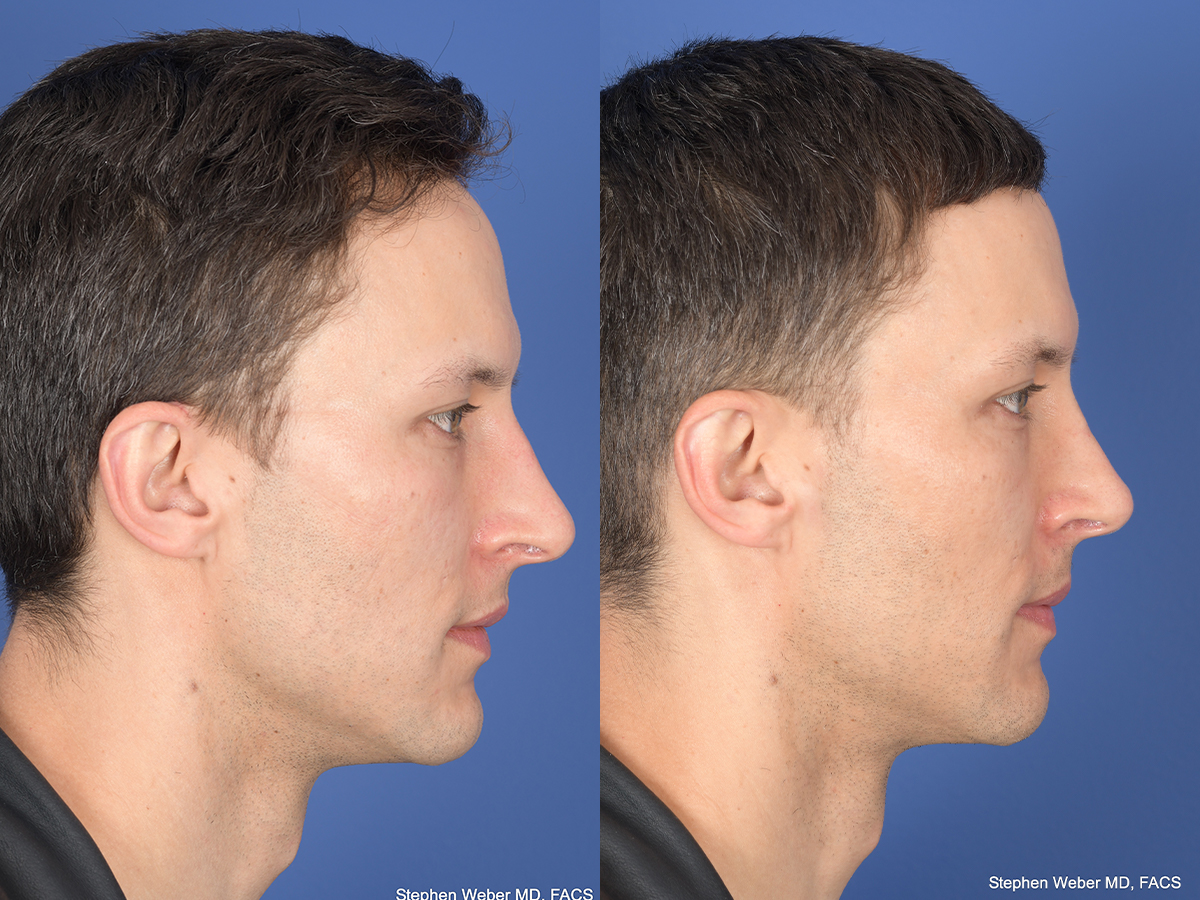 Rhinoplasty Before and After | Weber Facial Plastic Surgery
