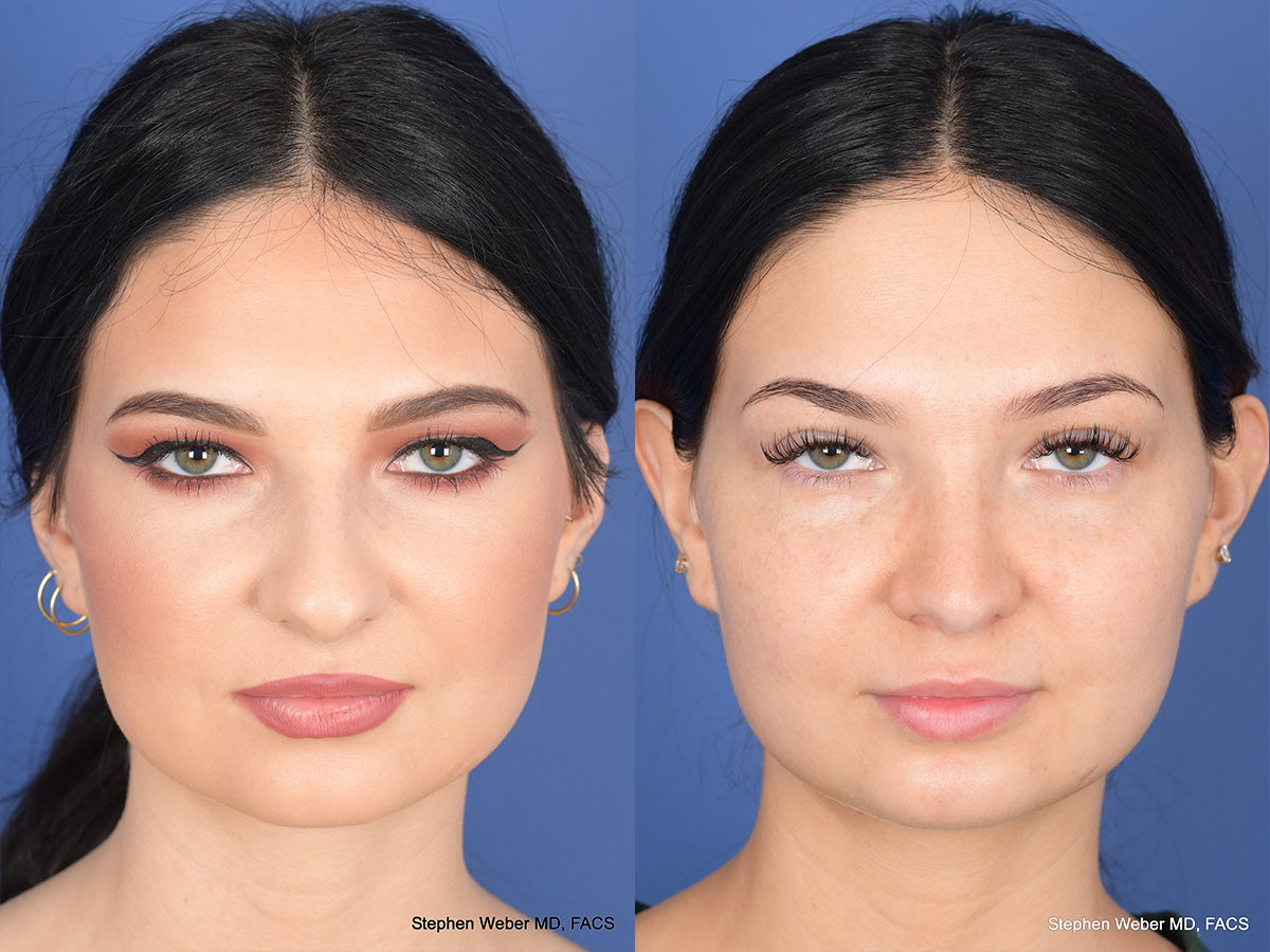 Rhinoplasty Before and After | Weber Facial Plastic Surgery