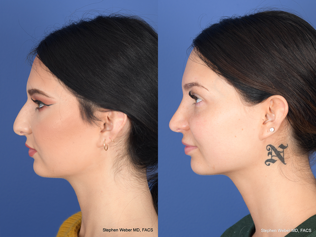 Rhinoplasty Before and After | Weber Facial Plastic Surgery