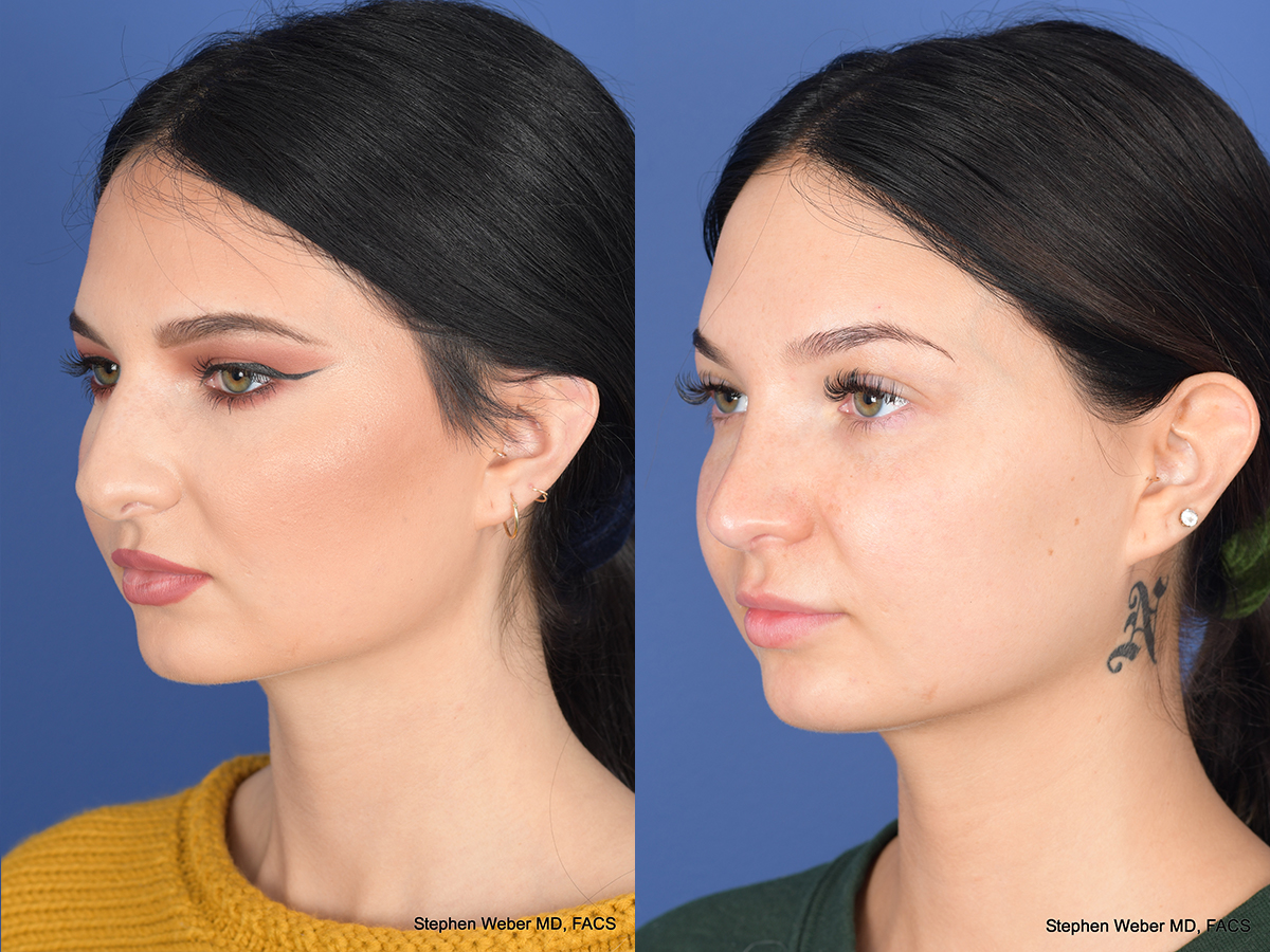 Rhinoplasty Before and After | Weber Facial Plastic Surgery