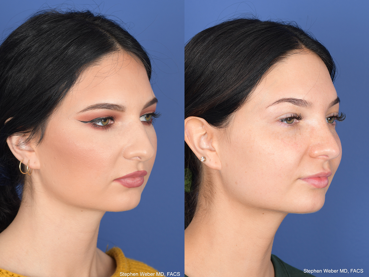 Rhinoplasty Before and After | Weber Facial Plastic Surgery
