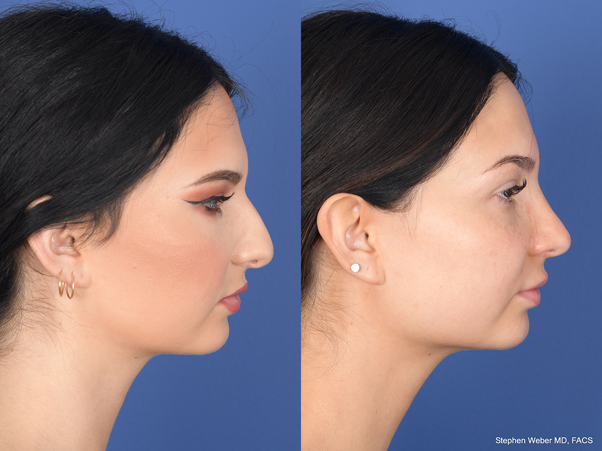 Rhinoplasty Before and After | Weber Facial Plastic Surgery