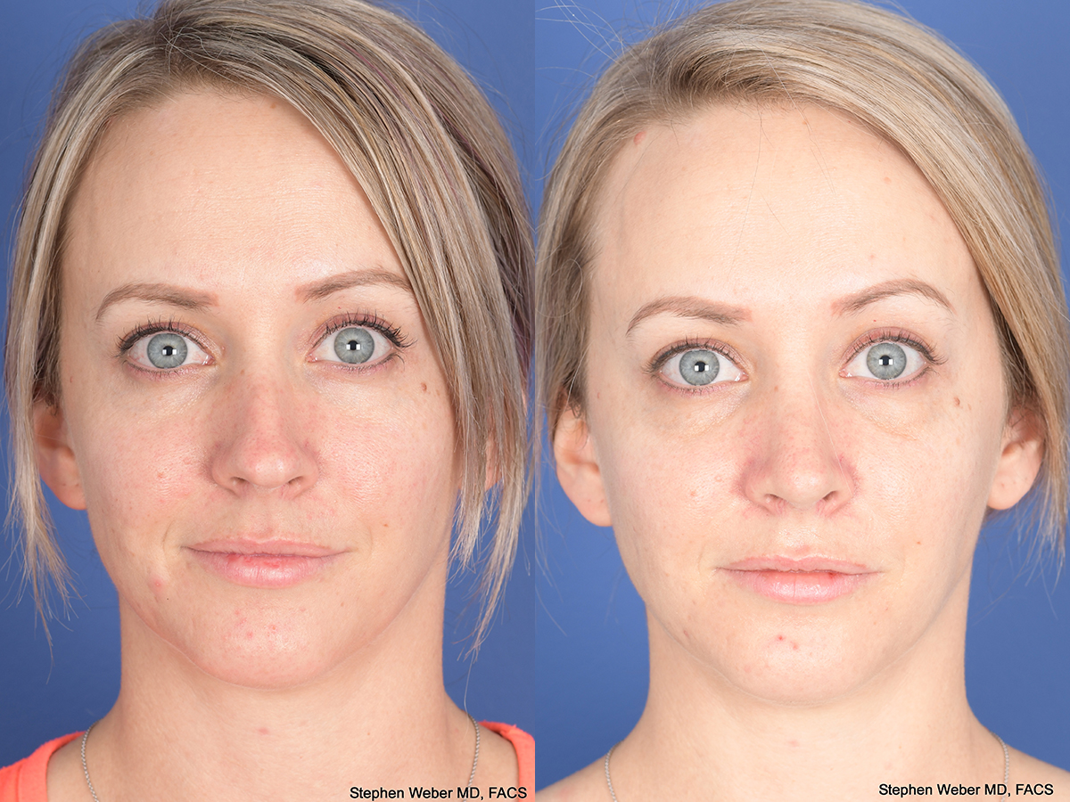Rhinoplasty Before and After | Weber Facial Plastic Surgery