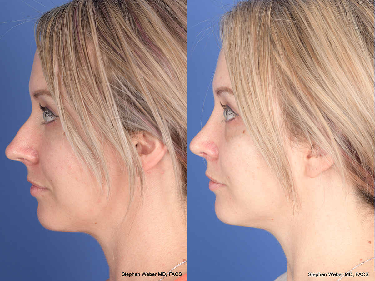 Rhinoplasty Before and After | Weber Facial Plastic Surgery