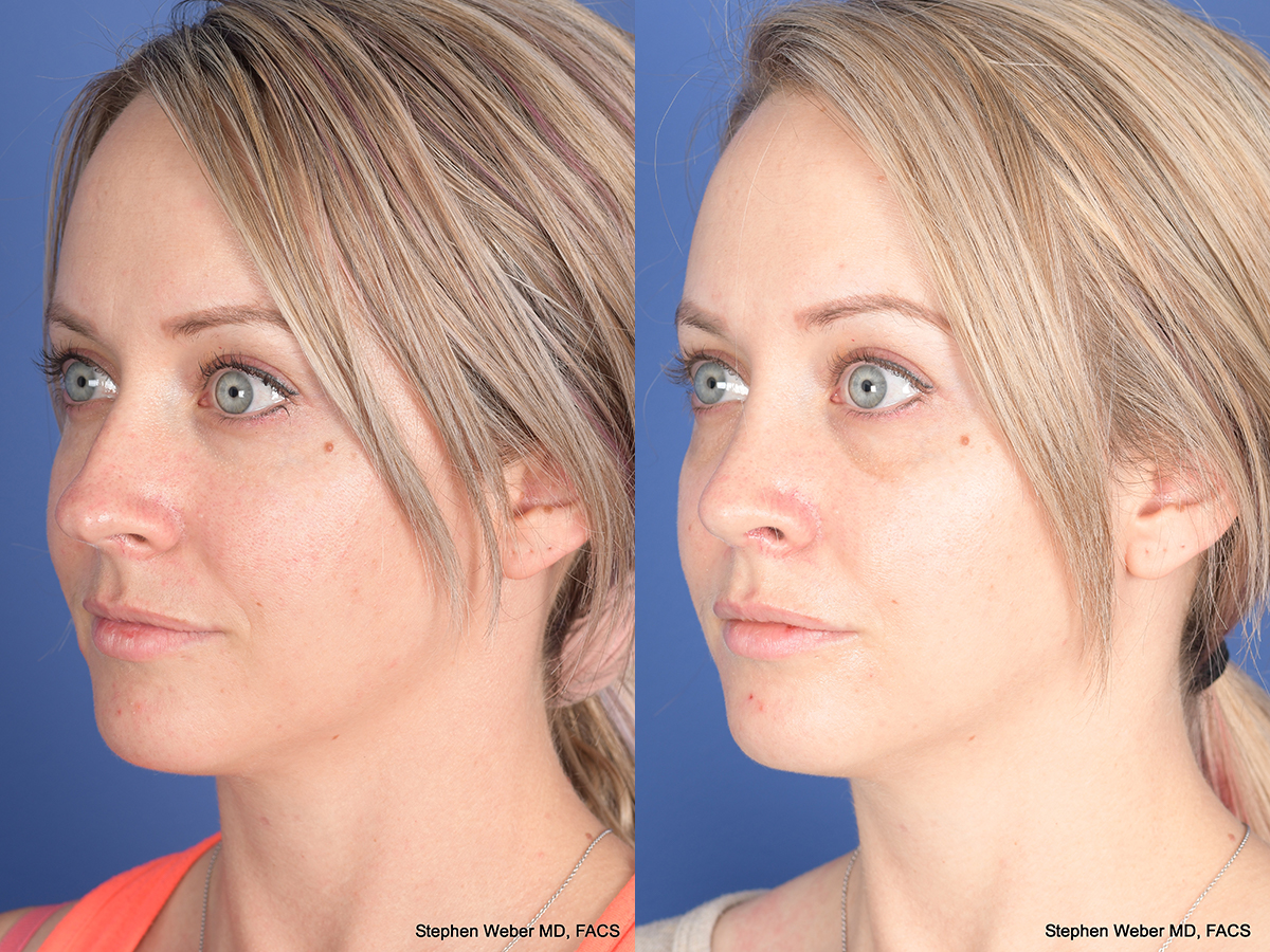 Rhinoplasty Before and After | Weber Facial Plastic Surgery