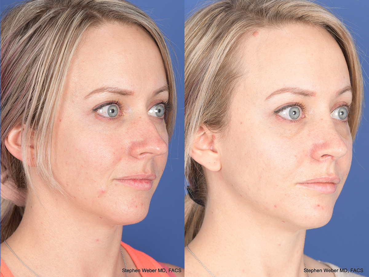 Rhinoplasty Before and After | Weber Facial Plastic Surgery