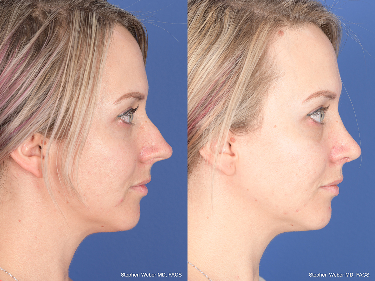 Rhinoplasty Before and After | Weber Facial Plastic Surgery