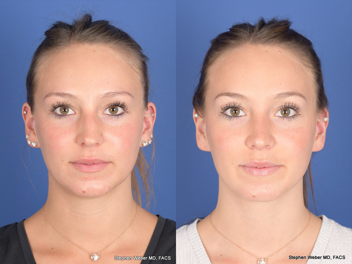 Rhinoplasty Before and After | Weber Facial Plastic Surgery