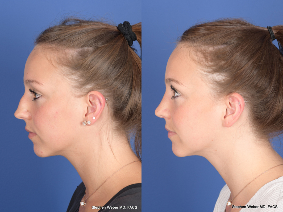 Rhinoplasty Before and After | Weber Facial Plastic Surgery