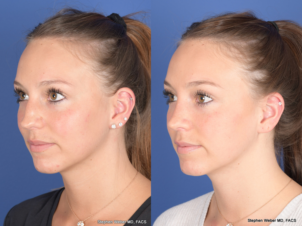 Rhinoplasty Before and After | Weber Facial Plastic Surgery