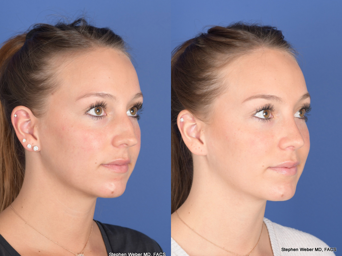 Rhinoplasty Before and After | Weber Facial Plastic Surgery