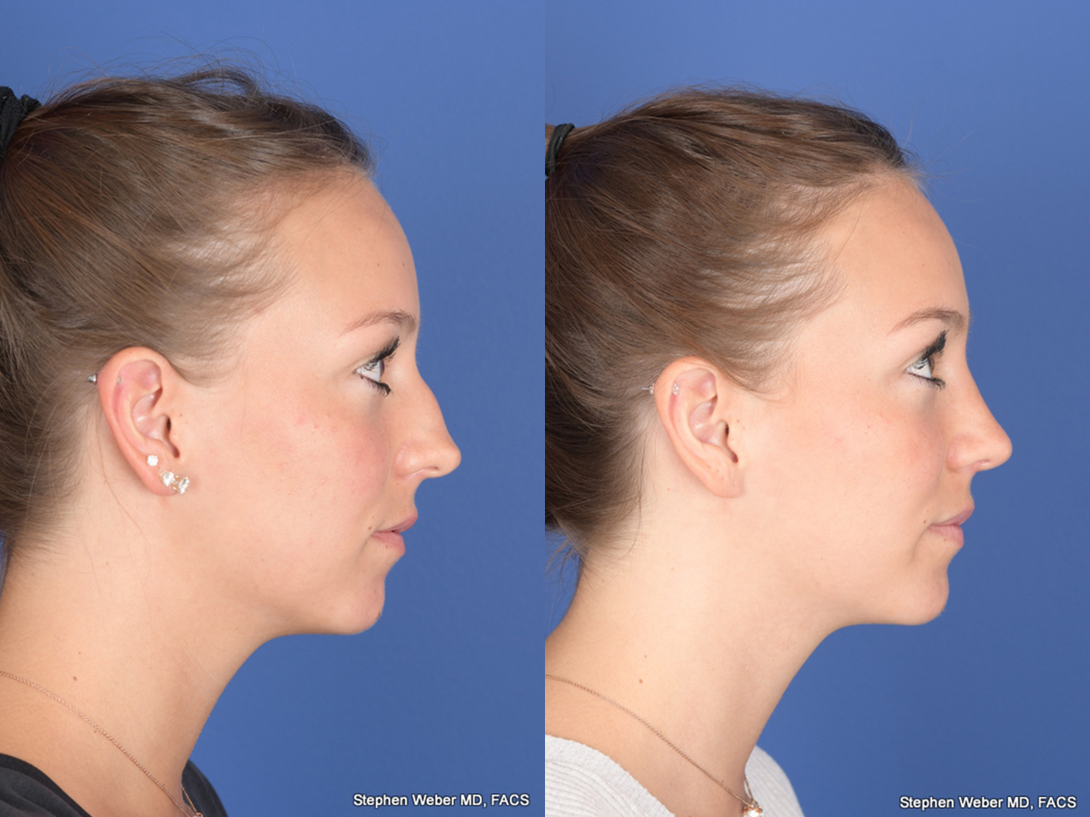 Rhinoplasty Before and After | Weber Facial Plastic Surgery
