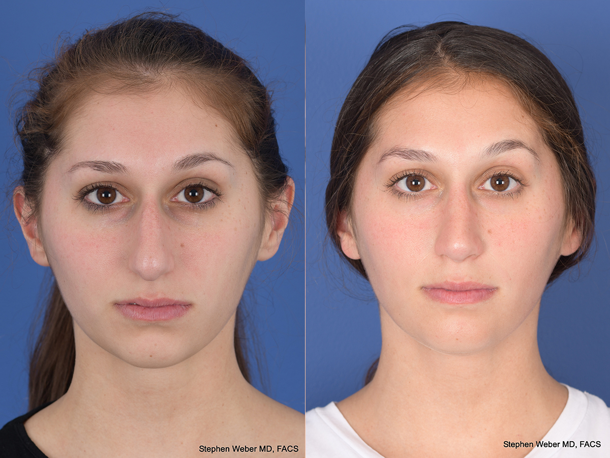 Rhinoplasty Before and After | Weber Facial Plastic Surgery