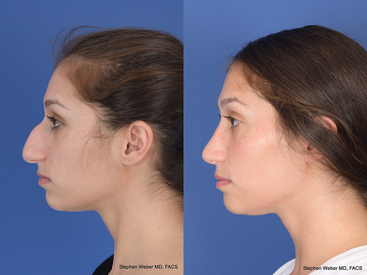 Rhinoplasty Before and After | Weber Facial Plastic Surgery