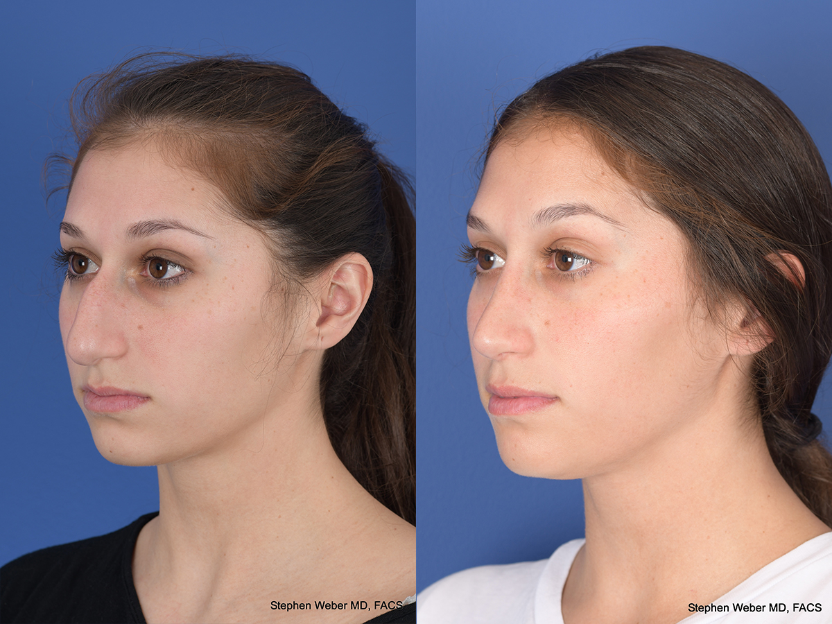 Rhinoplasty Before and After | Weber Facial Plastic Surgery