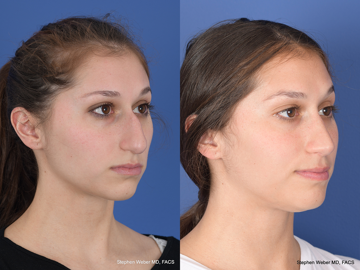 Rhinoplasty Before and After | Weber Facial Plastic Surgery