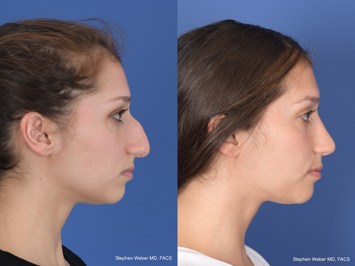 Rhinoplasty Before and After | Weber Facial Plastic Surgery