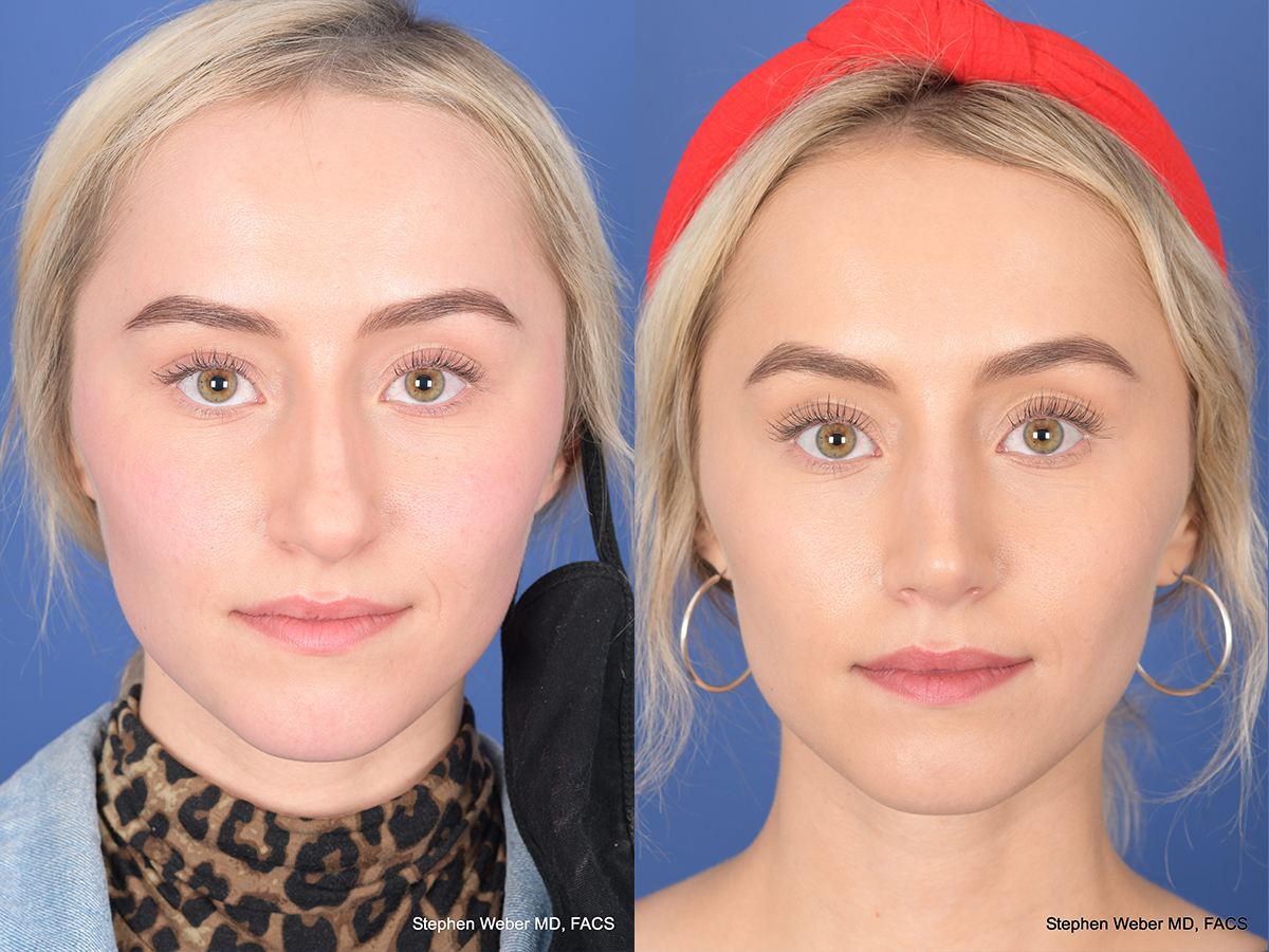 Rhinoplasty Before and After | Weber Facial Plastic Surgery