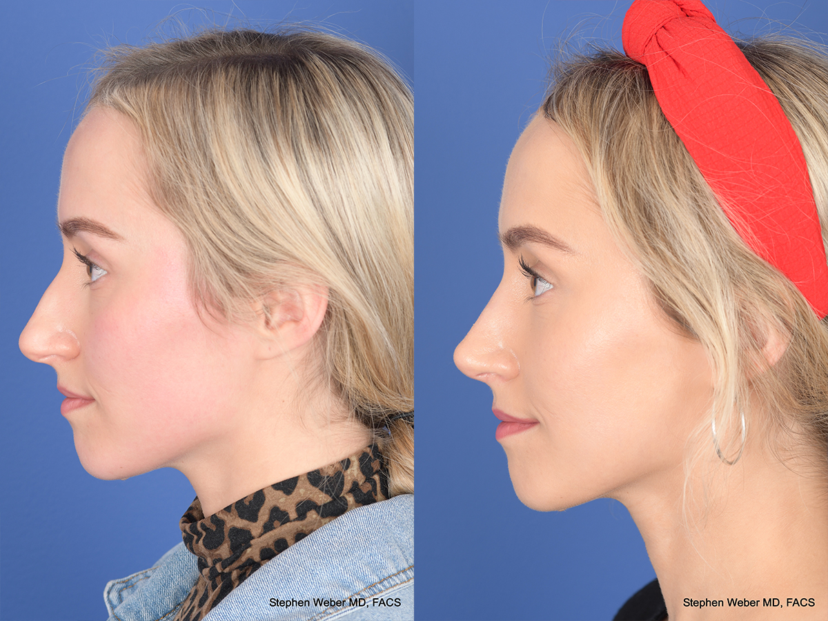 Rhinoplasty Before and After | Weber Facial Plastic Surgery