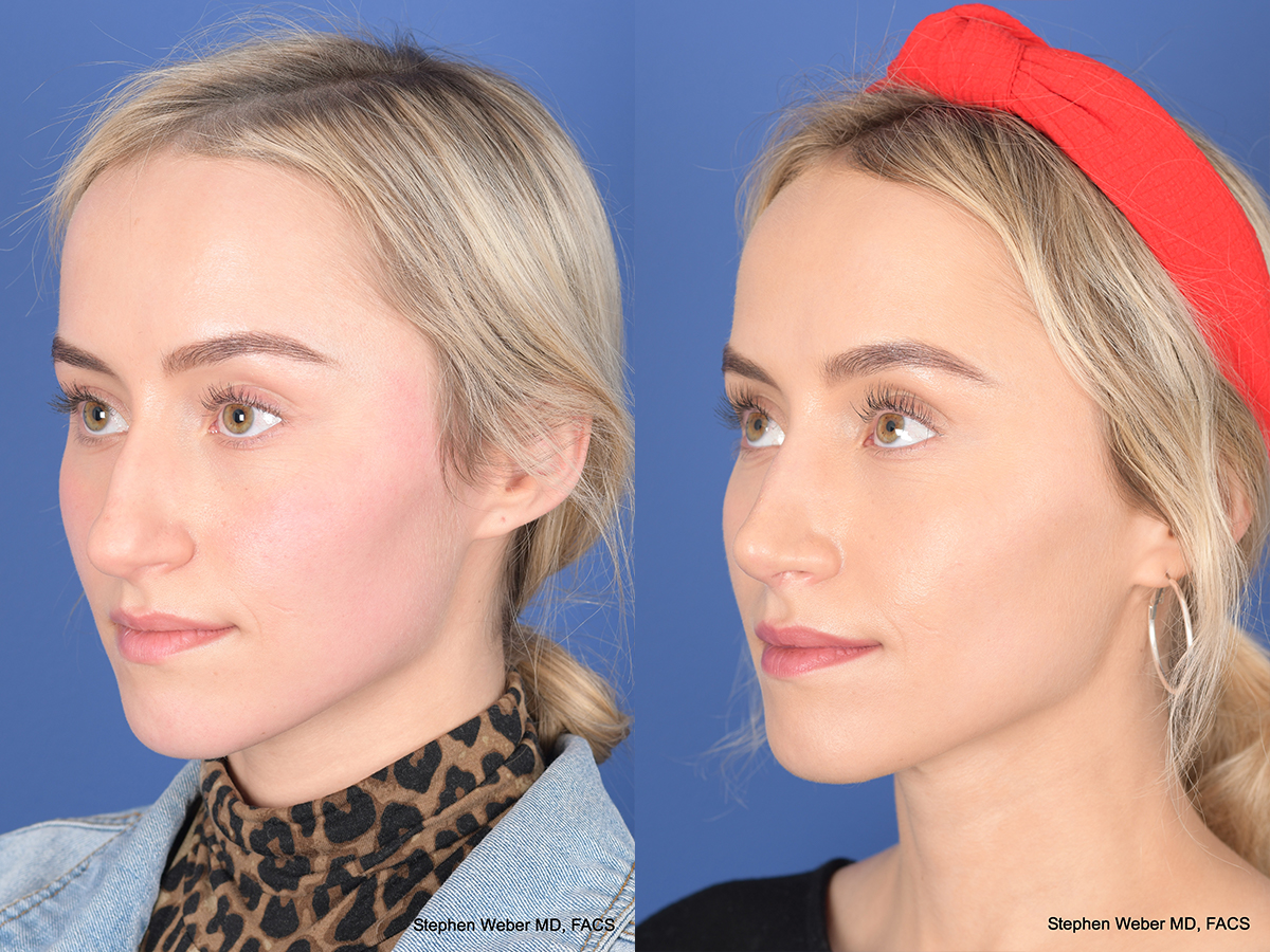 Rhinoplasty Before and After | Weber Facial Plastic Surgery