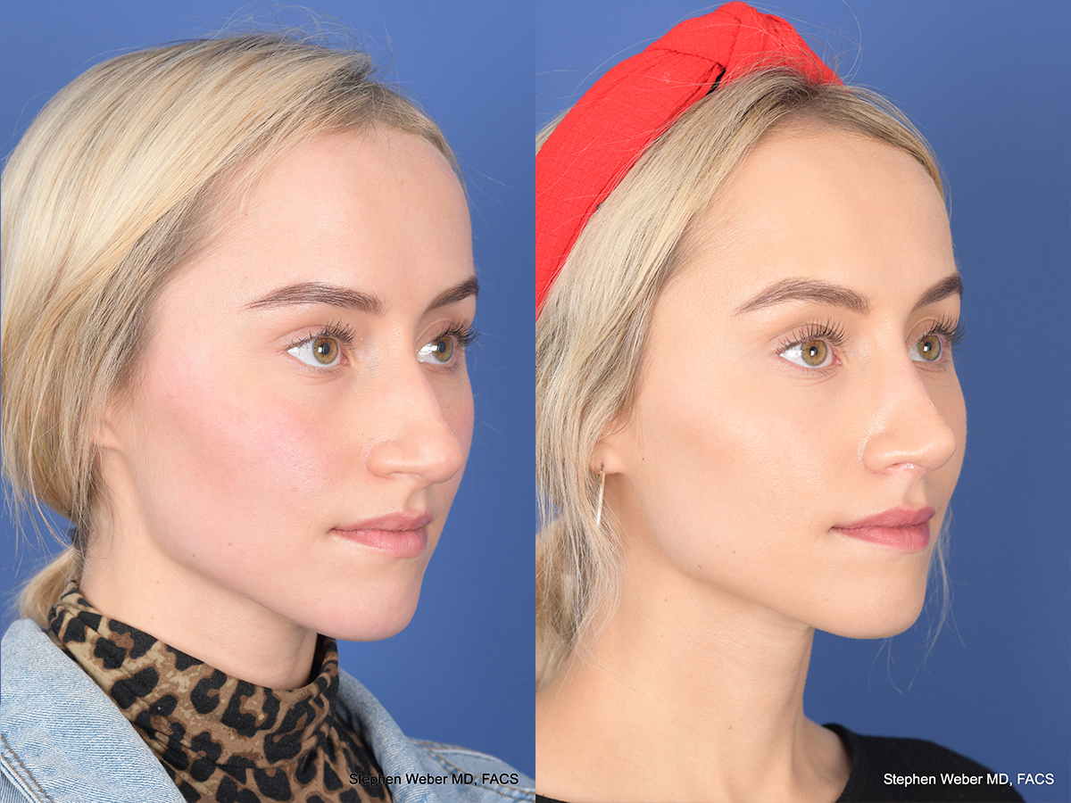Rhinoplasty Before and After | Weber Facial Plastic Surgery