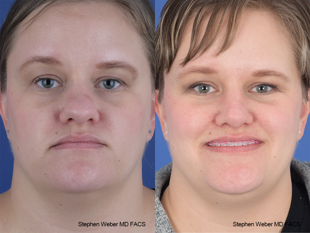 Rhinoplasty Before and After | Weber Facial Plastic Surgery