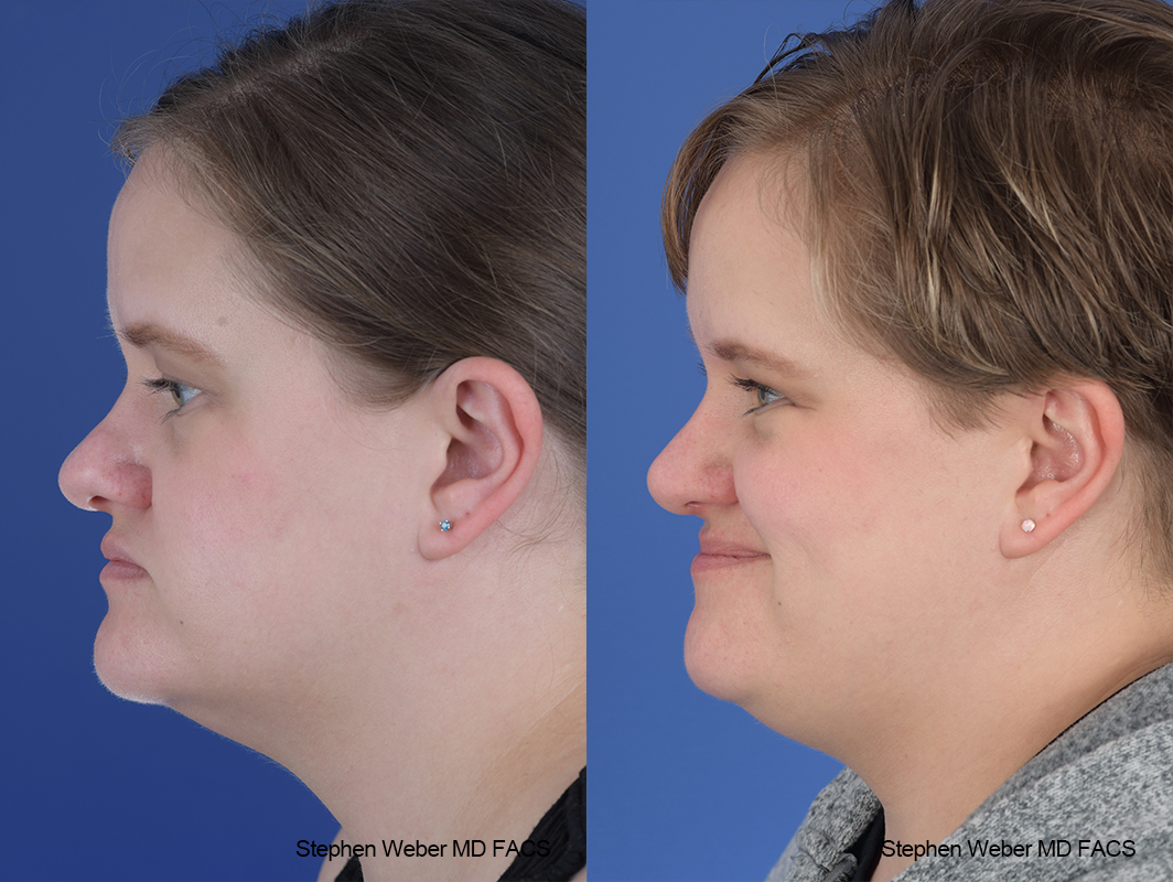 Rhinoplasty Before and After | Weber Facial Plastic Surgery