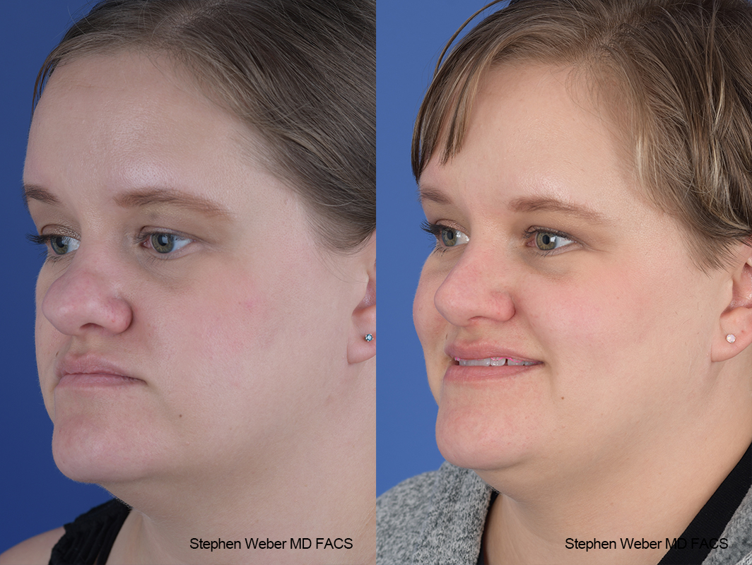 Rhinoplasty Before and After | Weber Facial Plastic Surgery