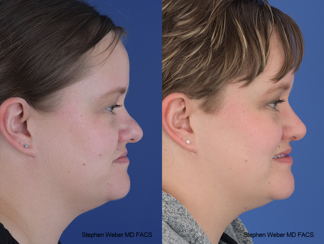 Rhinoplasty Before and After | Weber Facial Plastic Surgery