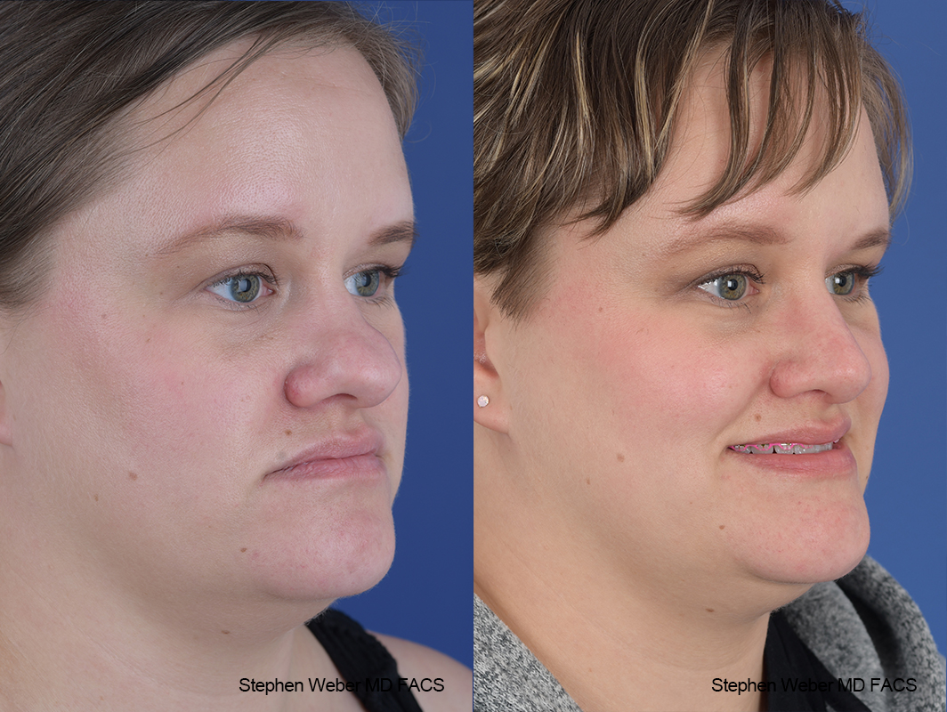 Rhinoplasty Before and After | Weber Facial Plastic Surgery